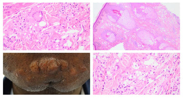 What Is An Expert? And What Does That Mean For 'Skin of Colour' Dermatology?