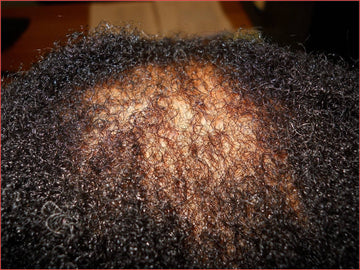 Medscape Europe Highlights EADV Conference  Session on Skin of Colour